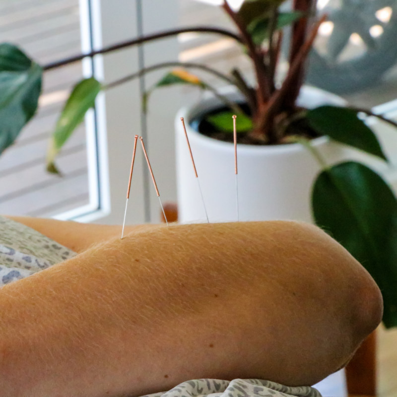 dry needling in arm